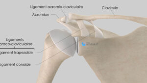 Comment gérer une luxation acromio-claviculaire de stade 3 ?