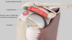 Comment traiter la tendinopathie calcifiante du supra-épineux sans chirurgie ?