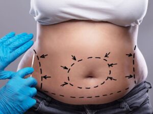 Comment lutter contre l'obésité androïde pour améliorer votre santé ?