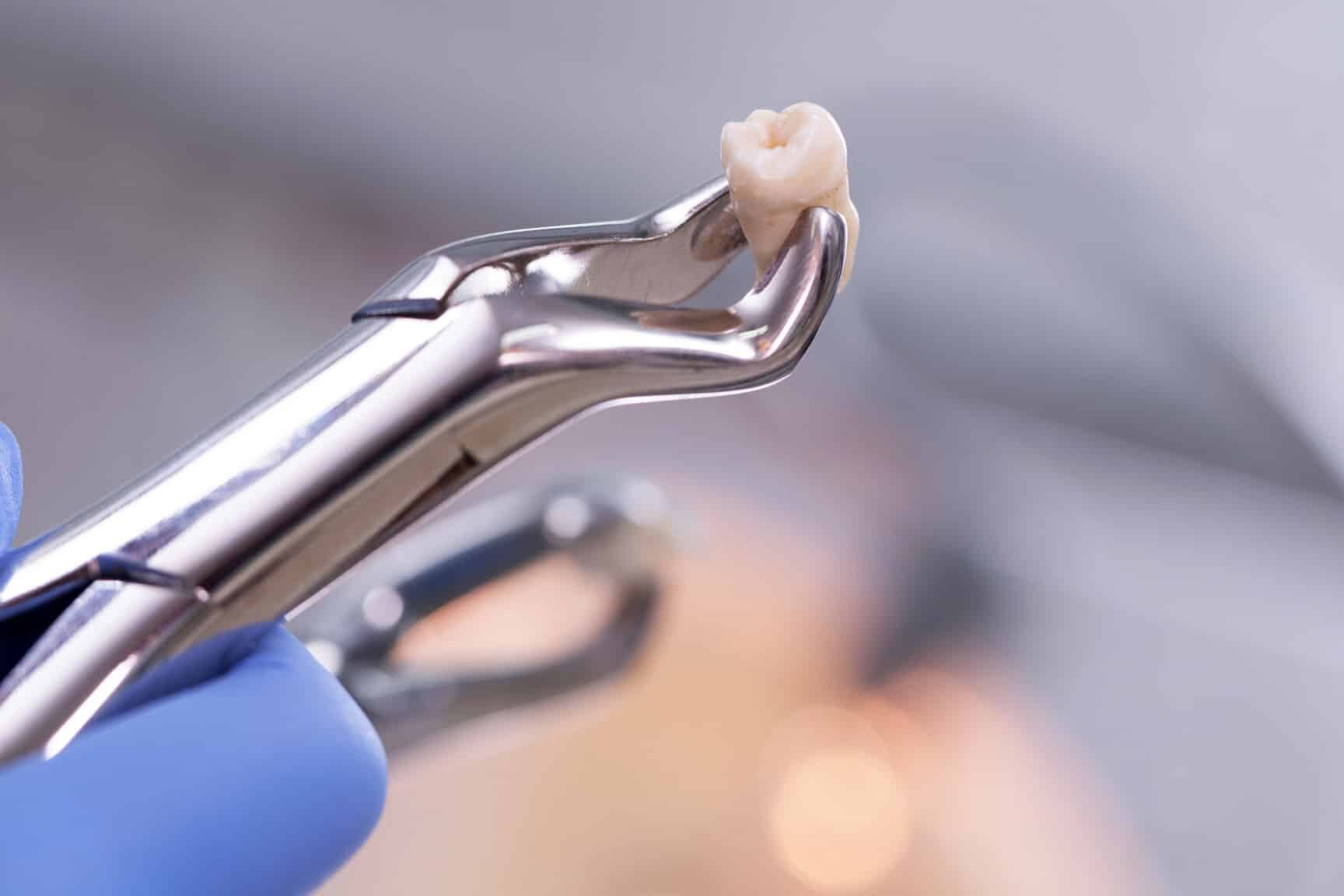Combien de temps reste un caillot après une extraction dentaire ?