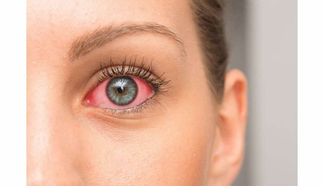 Covid et yeux rouges : quel est le lien ?