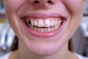 Pourquoi des triangles noirs apparaissent-ils entre vos dents et comment les éviter ?