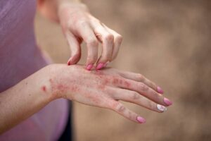 irritations main eczema