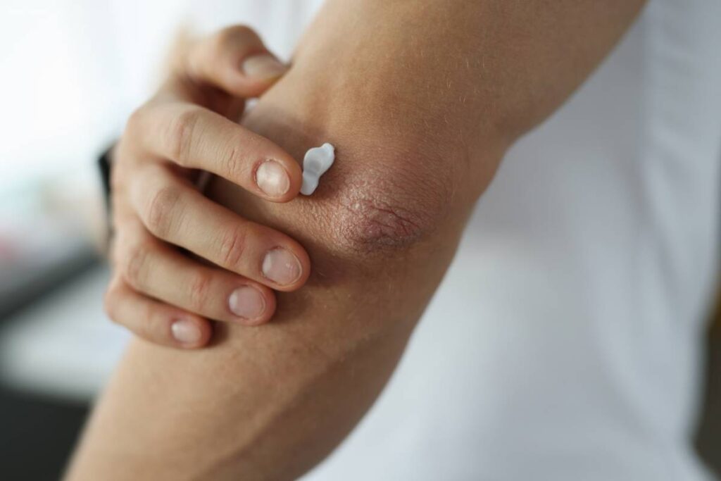 crème pour soulager eczéma