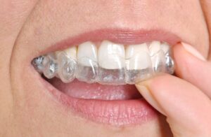 Aligner ses dents par gouttetières invisibles Aligneurs English