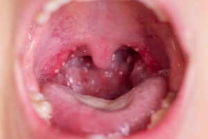 Angine : pourquoi une rechute après un traitement antibiotique est-elle possible ?