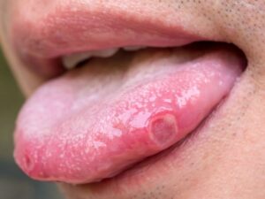 Comment traiter les aphtes sur la langue avec des huiles essentielles ?