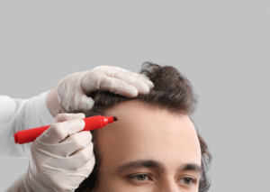 greffe cheveux