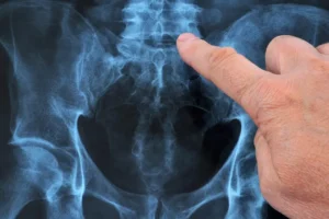 Est-il possible de Travailleur Avec une arthrodèse Lombaire?