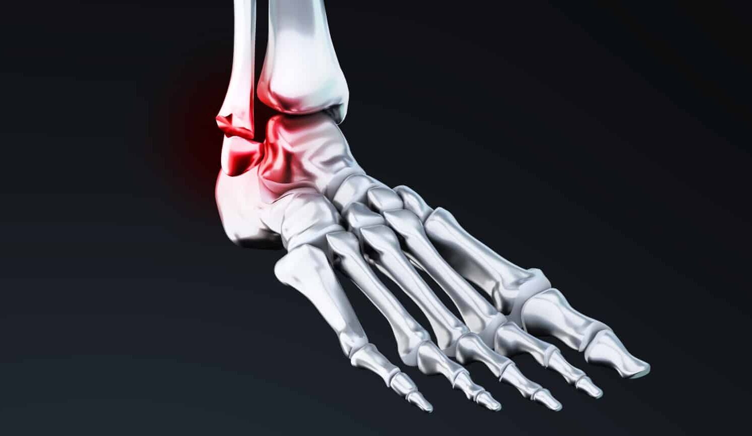 Fracture Bimalléolaire: symptômes, provoque des dépôts et