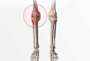 Fracture du Plateau Tibial: symptômes, provoques et dépôts