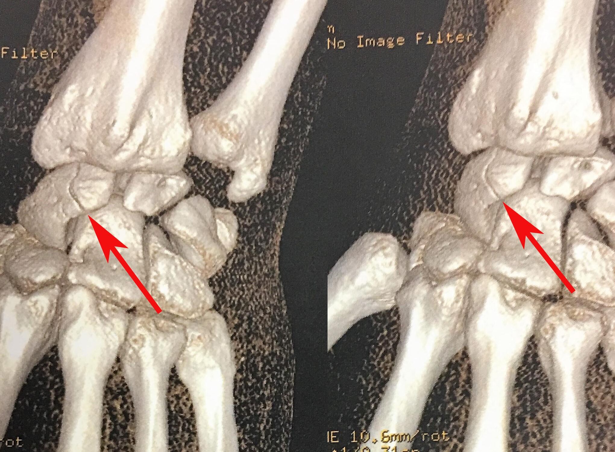 Fracture du Scaphoïde: Symptômes, Soins et Guérison