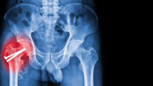 Fracture Pertrochantirienne: symptômes et dépassions