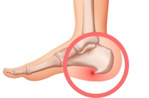 Douleur Au Talon: Peut-Elle Révéler Un Cancer?