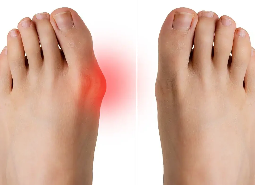 Douleur Lancinante Après Hallux Valgus: Que Faire?
