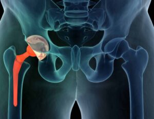 Douleurs Musculaires APRÈS UNE PROTHÈSE DE HANCHE: Que Faire?