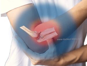 Fracture de la Tête Radiale: symptômes et dépassements