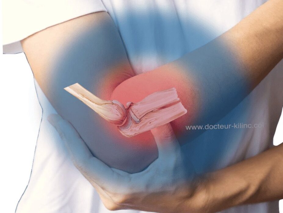 Fracture de la Tête Radiale: symptômes et dépassements