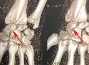 Fracture scaphoïde: symptômes, provoque des dépôts et