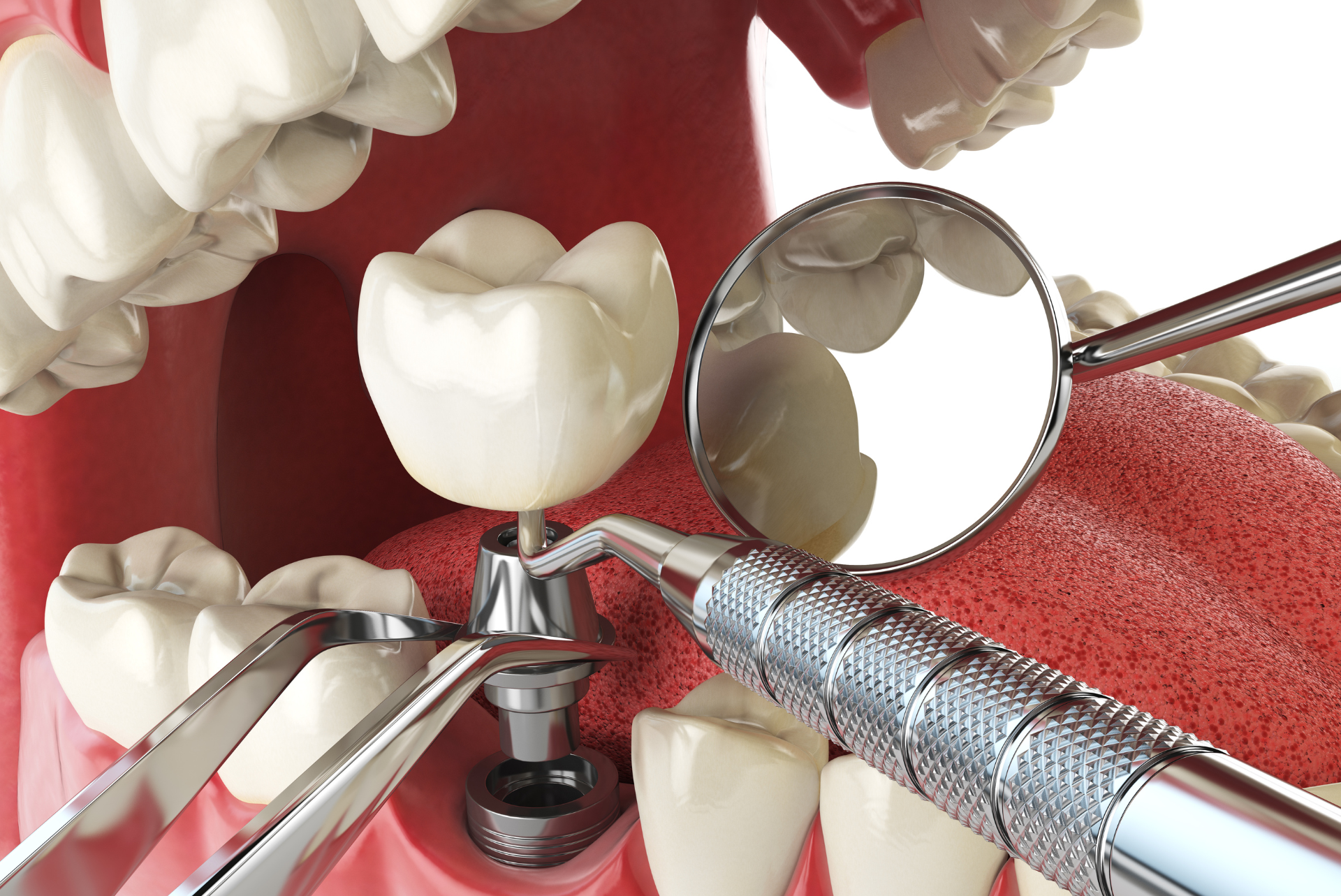 implant dentaire