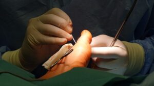 Combien demps verser le remarcher aptrès une fracture malléole?
