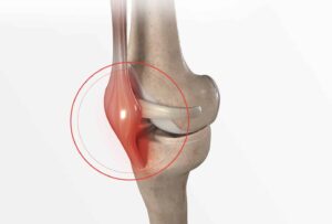 Douleur au ligament externe du Genou: que Faire?