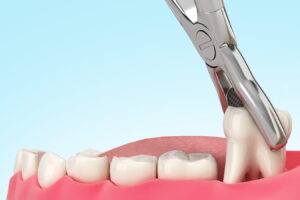 Extraction Dentaire: Douleur, Combien de Temps Cela Dure?