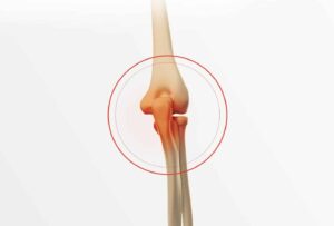 Fracture du Coude: combien de temps couler le guérir?