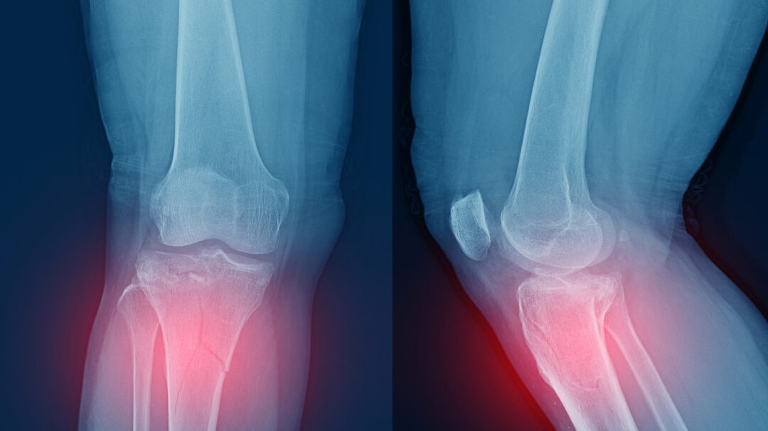 Fracture du Plateau Tibial: combien de tempéraments pour guérir