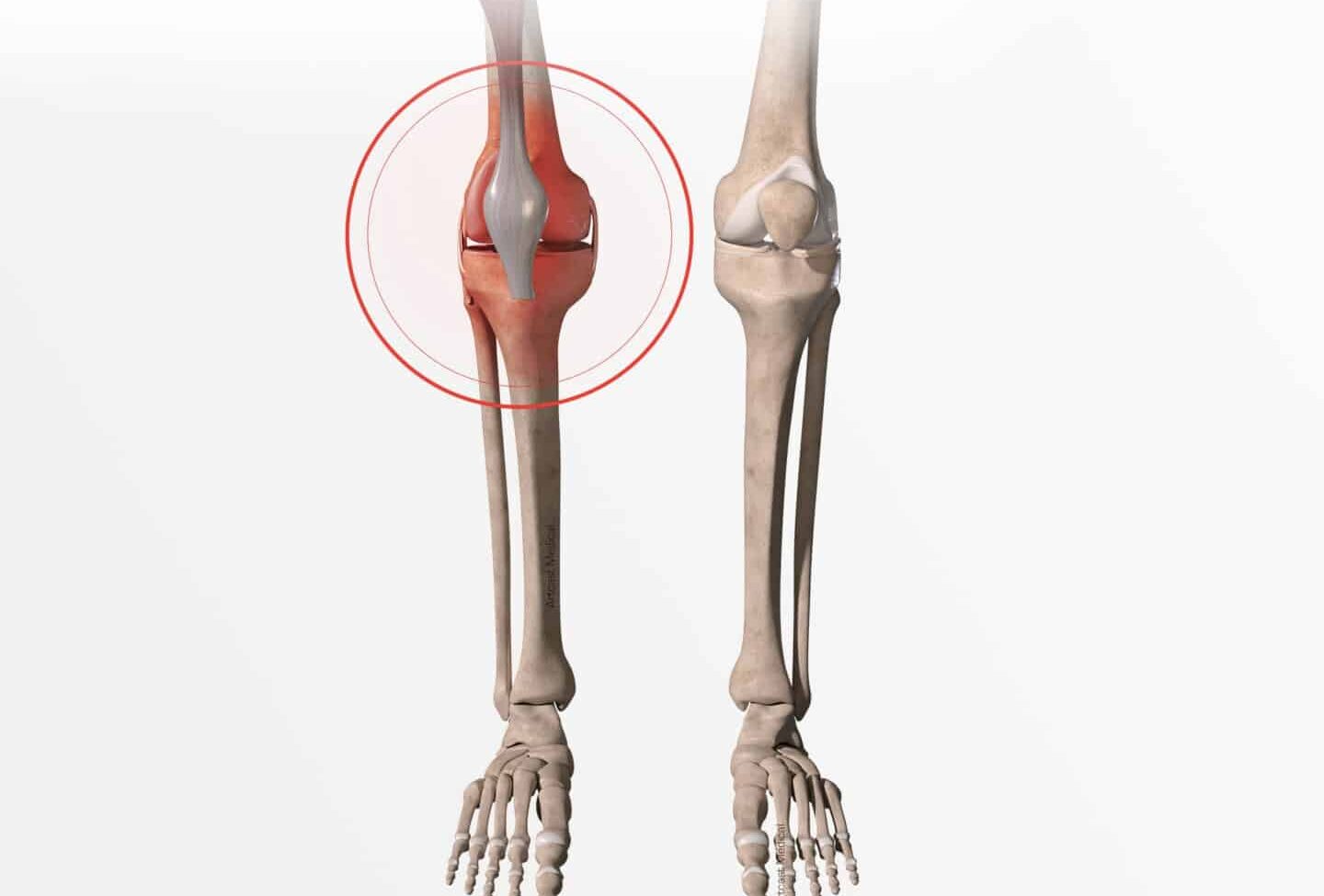 Fracture du Plateau tibial: symptômes, provoque et soins