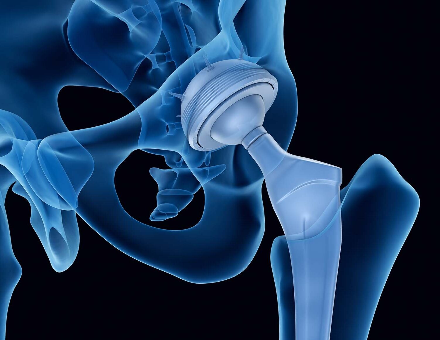 Douleurs Musculaires APPRÈS UNE PROTHÈSE DE HANCHE: Causes des solutions et