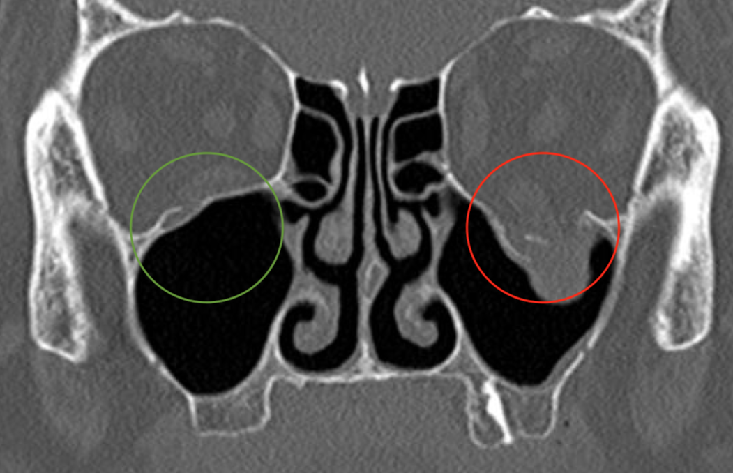 Fracture du Plancher Orbital: symptômes et dépassements