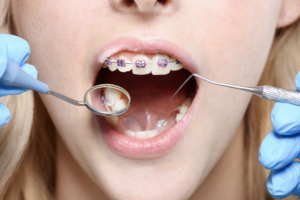 Appareil Dentaire: Que Faire Quand La Douleur est Trop Forte?