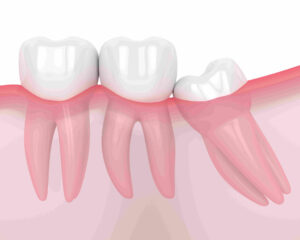 Dent de Sagesse: Que Faire en Cas de Douleur intense?