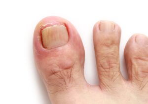 Douleur à l'Ongle du Gros Orteil Sous Pression: provoque des solutions et des solutions