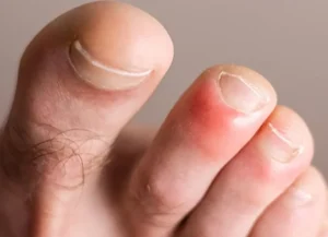 Douleur AU 2E Orteil: Causes, symptômes et dépassements