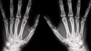 Douleur au Scaphoïde sans fracture: les quelles provoquent des provoques?