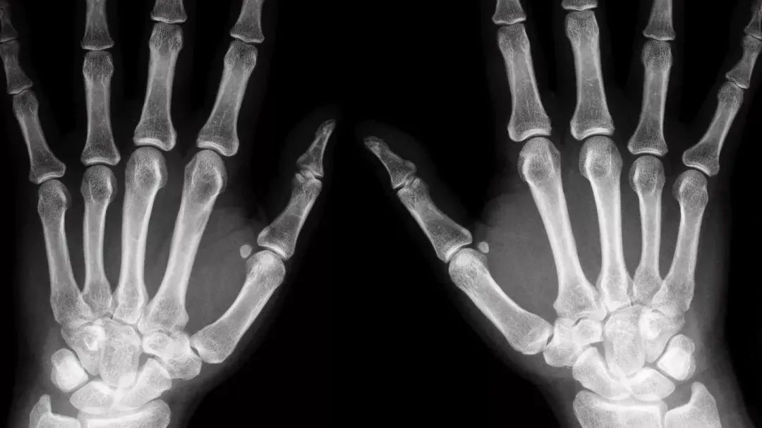 Douleur au Scaphoïde sans fracture: les quelles provoquent des provoques?