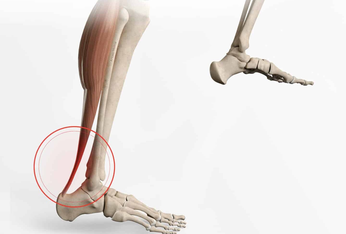 Douleur au Tendon d’Achille Auveil: Que Faire?
