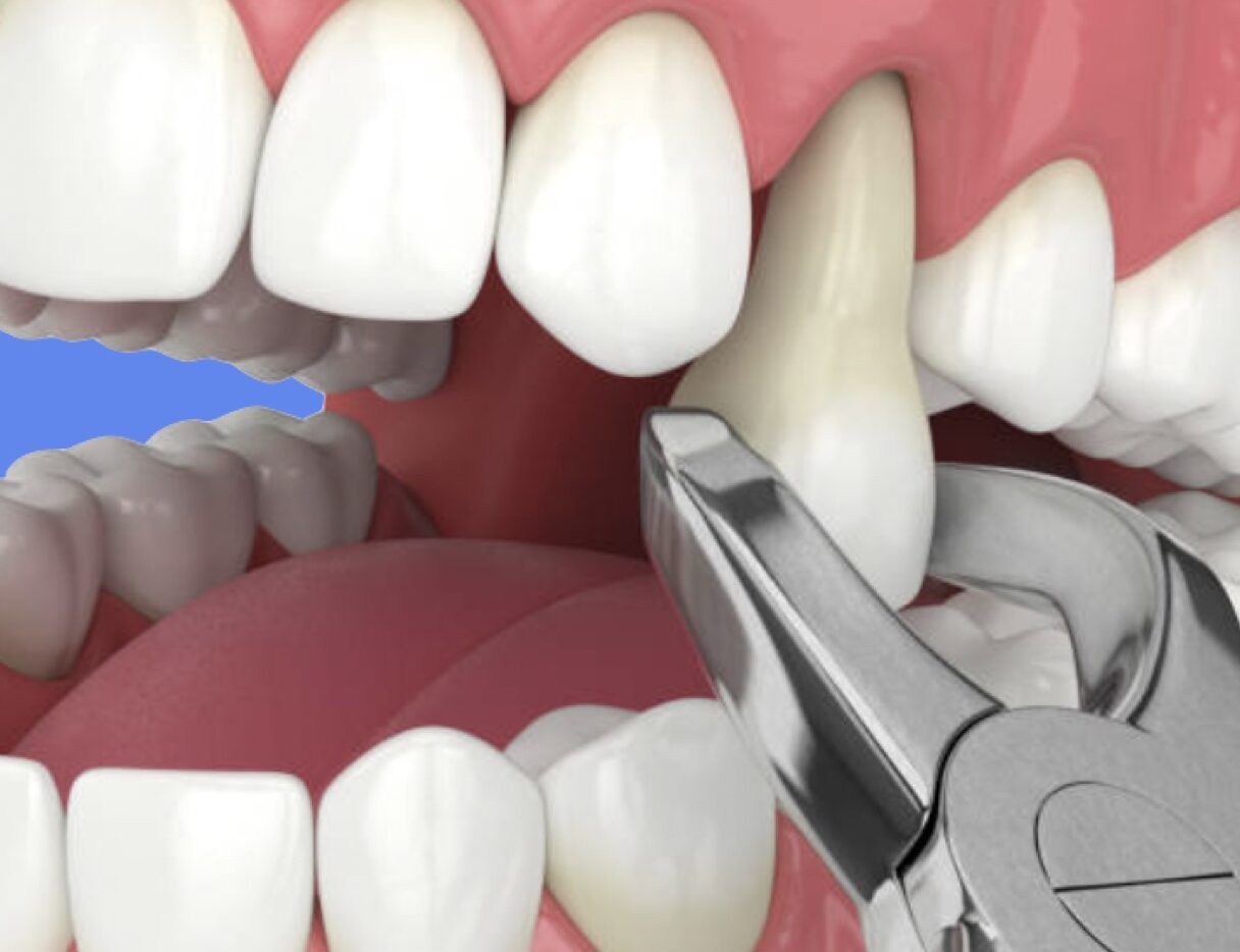 Douleur Dent Dévitalisée: Causes, signes et dépassements