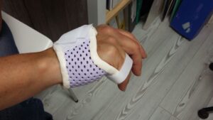 Fracture Métacarpe Main: Combien de Temps pour Guérir?